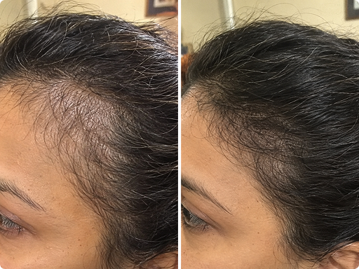 Real user results after 4 month of daily NutraEssence Scalp Revival Serum .