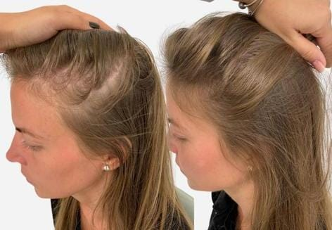 REPORTED THICKER, FULLER-LOOKING HAIR