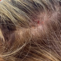 SCALP DRYNESS & INFLAMMATION